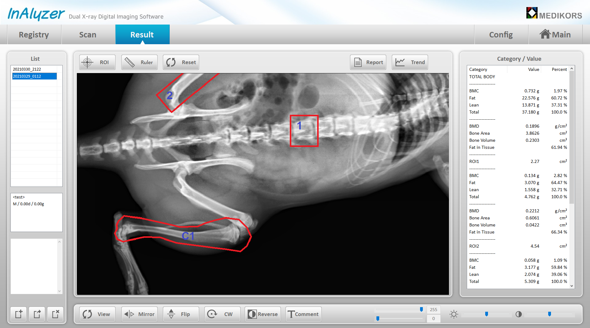 X-ray Bone densitometry