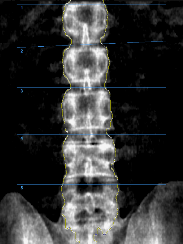AIR SPINE BMD IMAGE
