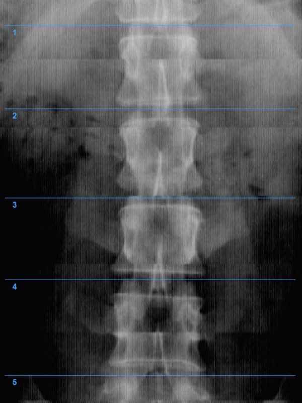 AIR SPINE DR IMAGE 4