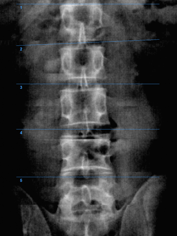 AIR_Spine DR image