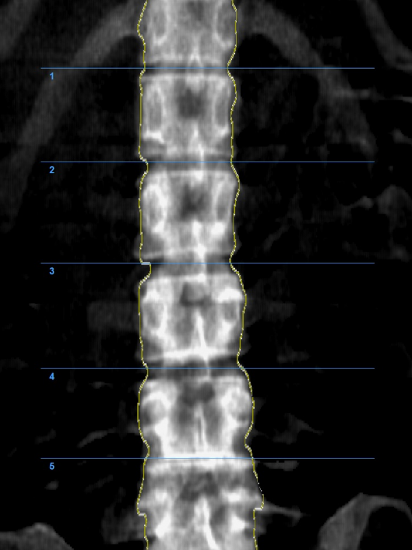 bmd spine image